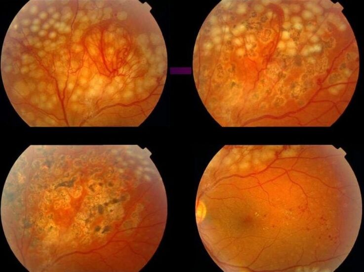 Retinopátia magas vérnyomás miatt